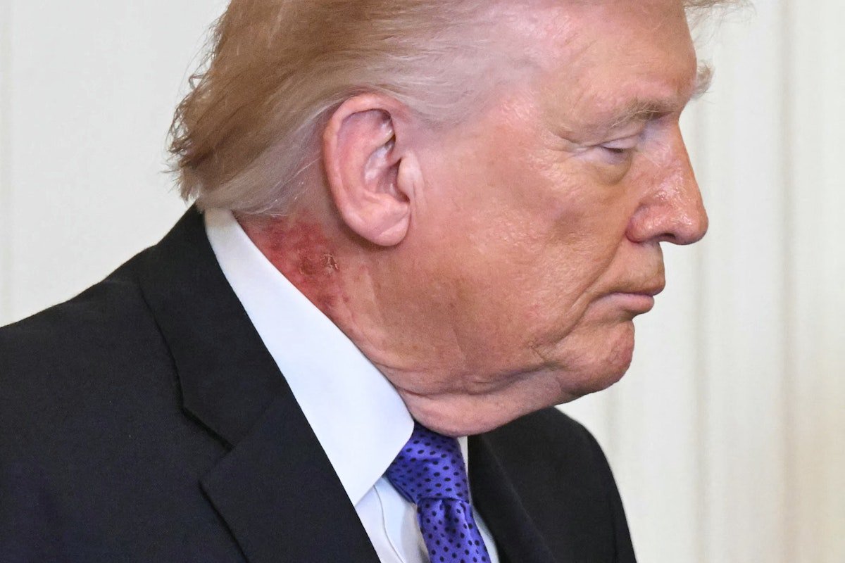 Trump Now Has a Giant, Crusty Rash on His Neck