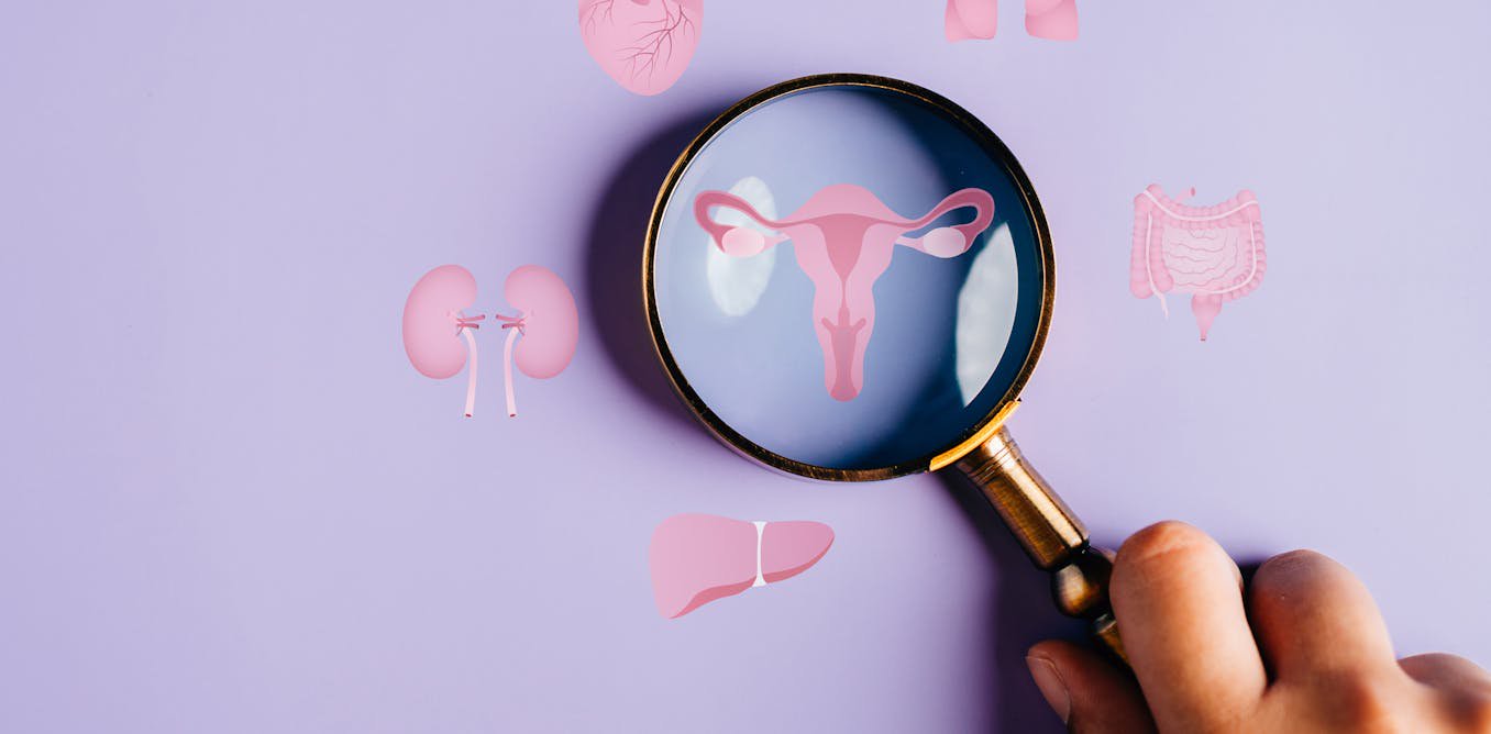 I’m a doctor who helped rename PCOS to PMOS – a 10-year process of listening to 14,000 patients and health professionals speak on how to improve care