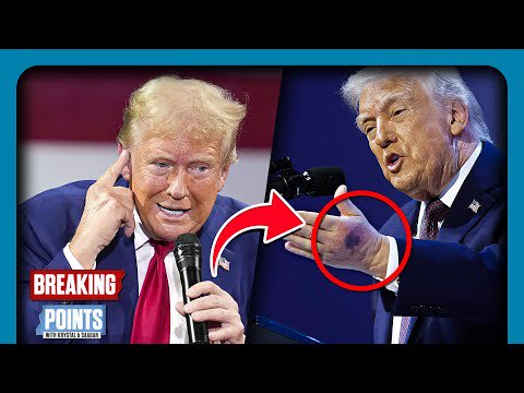 Trump FORGETS 'Alzheimers' After Bruise Incident