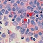 You’ve Never Been More Likely to Get Cancer, Survive Cancer, or Be Bankrupted by Cancer